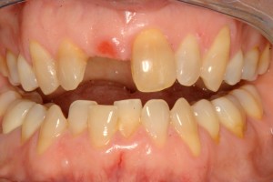 Pacific Beach San Diego patient prior to receiving dental implants in La Jolla - North Pacific Beach