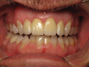 Patient after receiving a tooth replacement via tooth implant.