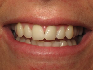 La Jolla - North Pacific Beach Invisalign patient before Acceledent.