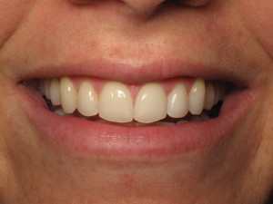 La Jolla Invisalign patient after Acceledent.