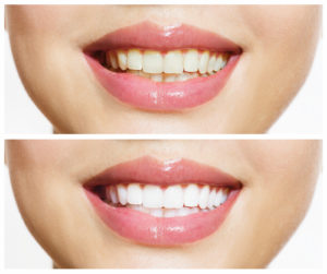 White teeth, courtesy of professional teeth whitening available to patients near La Jolla and Pacific Beach San Diego.