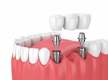 Implant dental bridge for La Jolla and Pacific Beach San Diego patients with missing teeth.