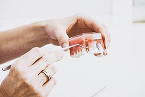 All on 4 denture implants acts like permanent dentures for patients in La Jolla and Pacific Beach San Diego.