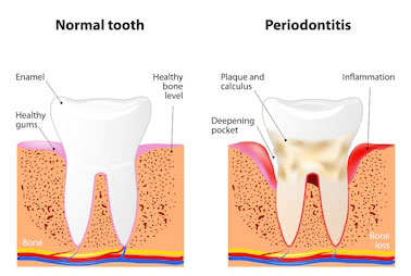 Advanced periodontal disease requires gum disease treatment for La Jolla and Pacific Beach patients.