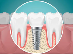 Most La Jolla and Pacific Beach  dental patients choose dental implants when having to pick between dentures vs implants.