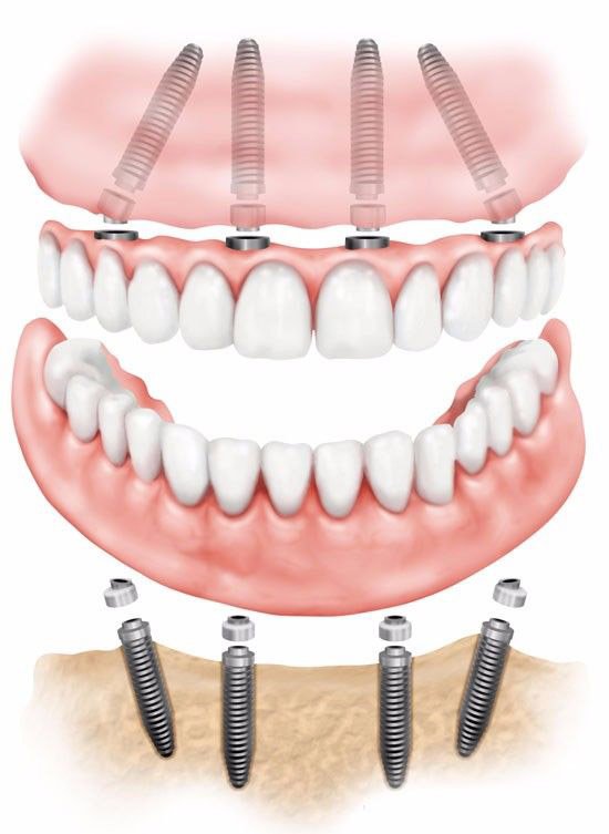 Implants vs Dentures Dentist in La Jolla Weston Spencer DDS