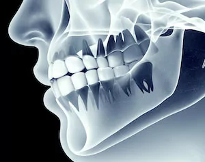 Dental Crowns La Jolla CA - Weston Spencer DDS Pacific Beach