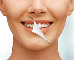 Teeth Whitening La Jolla - Dr weston Spencer DDS Pacific Beach San Diego