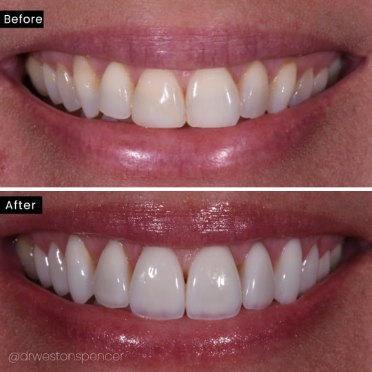 Before and After Veneers