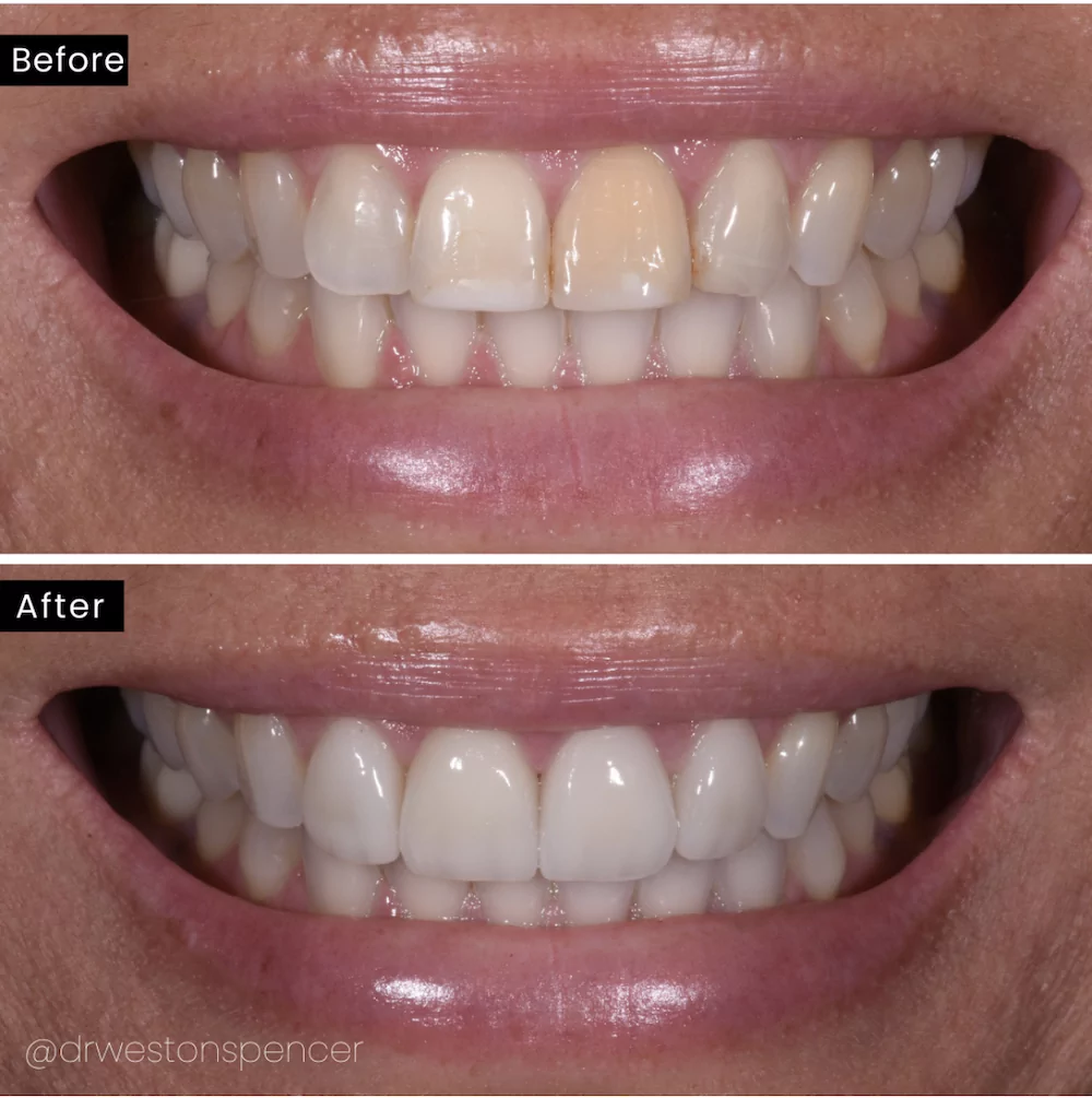 Dientes Postizos Temporal Sonrisa Dental Carilla Estetica - VERALY