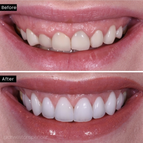 before & after veneers