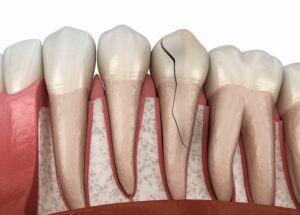 Broken Tooth Repair - Cracked Tooth Repair - Weston Spencer DDS - La Jolla CA